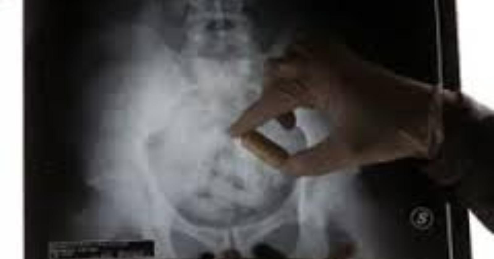 radiografia ovuli nell'addome