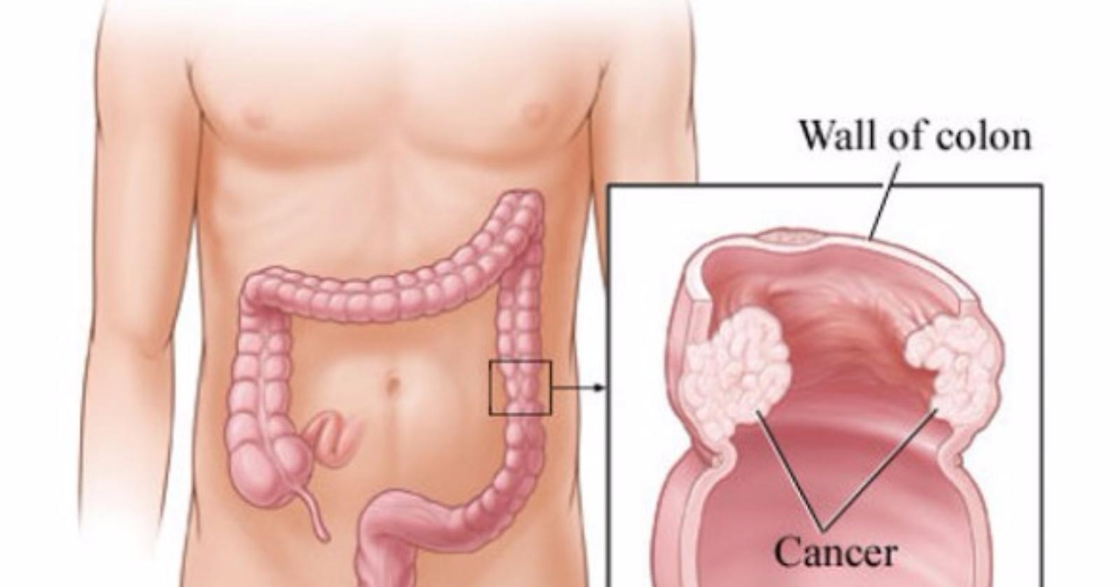 OO.RR., focus sul carcinoma della prostata e del retto