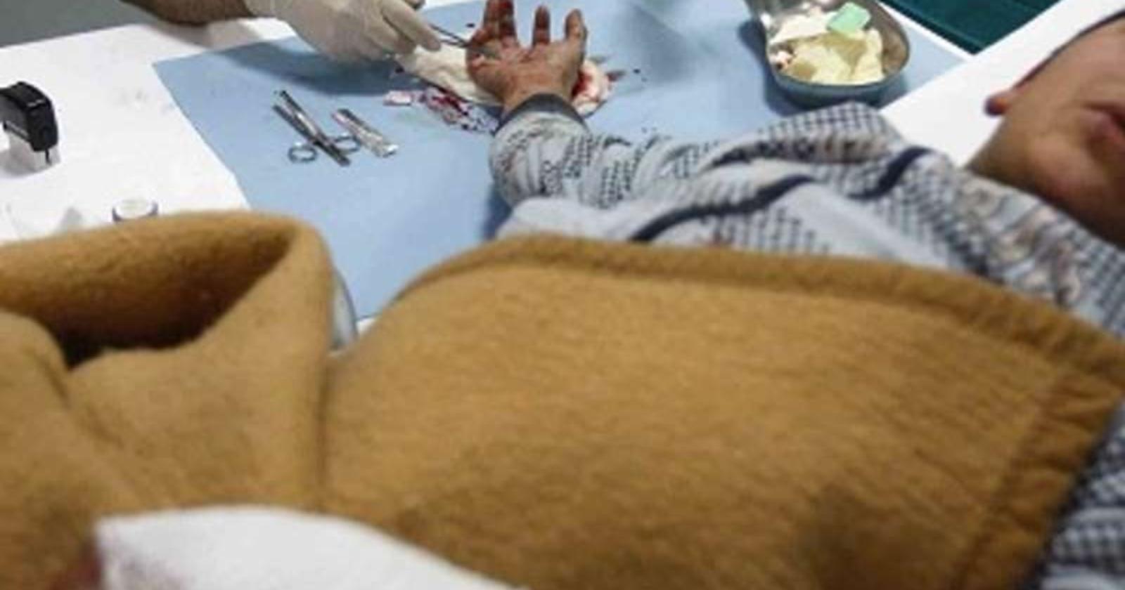 Botti di fine anno, si aggrava il numero dei feriti: 21enne perde la mano destra