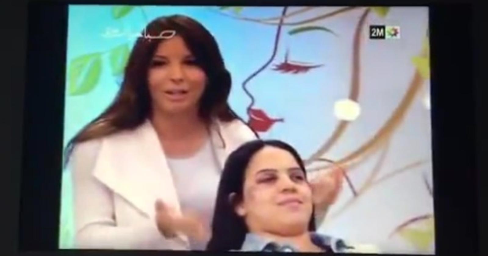 Quei lividi che non vengono via col trucco
