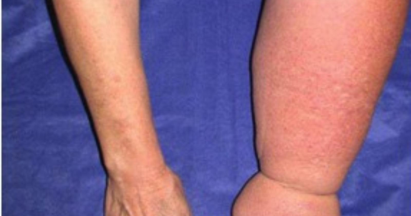 Linfedema, la malattia rara misconosciuta “compressa” dal silenzio