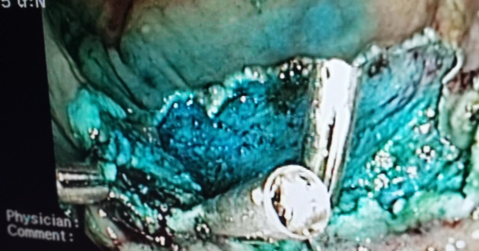 Ospedale di Melfi, eseguito per la prima volta intervento endoscopico innovativo 