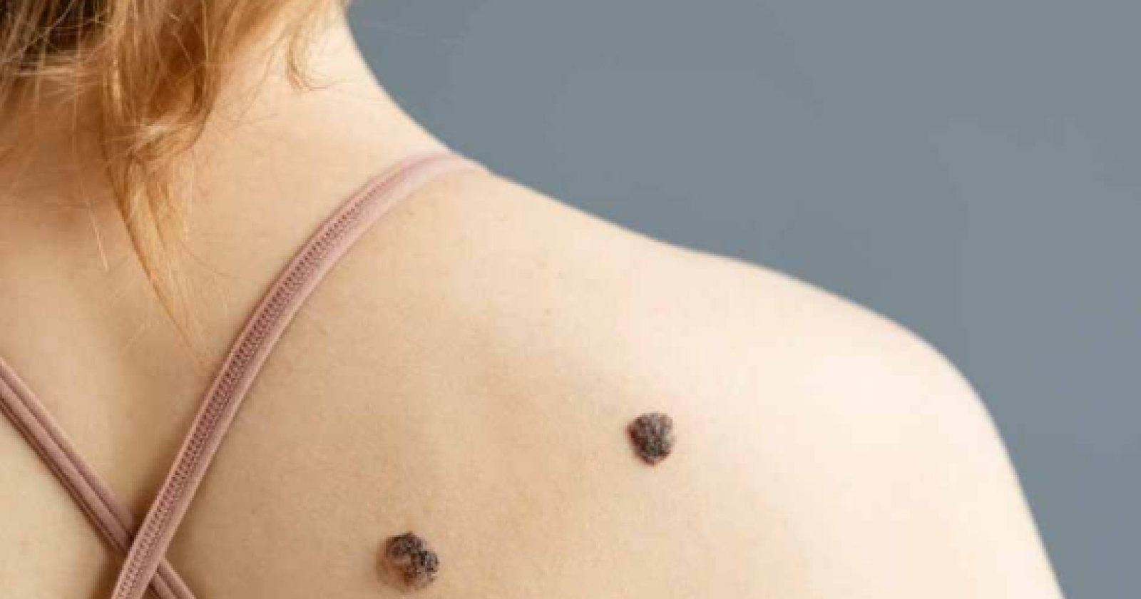 Facciamo luce sul melanoma: presentato un documento con 10 richieste alle istituzioni 