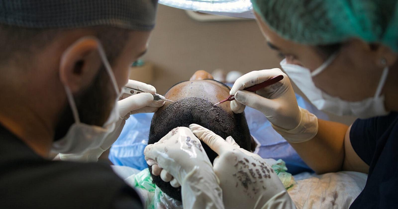 Il miglior trapianto di capelli in Turchia: la meta preferita per la "rinascita" della chioma