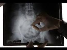 Dal Marocco a Foggia, la cocaina si trasportava così: ingoiandola
