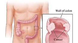 OO.RR., focus sul carcinoma della prostata e del retto
