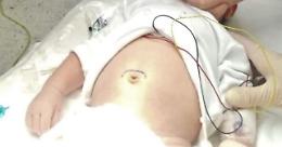Al San Carlo di Potenza intervento di alta chirurgia neonatale su un paziente di soli 27 giorni