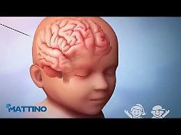 L'epilessia improvvisa a una bambina di 6 anni a Biccari ha colto tutti di sorpresa: il prof. Vigevano del San Raffaele ci spiega perché
